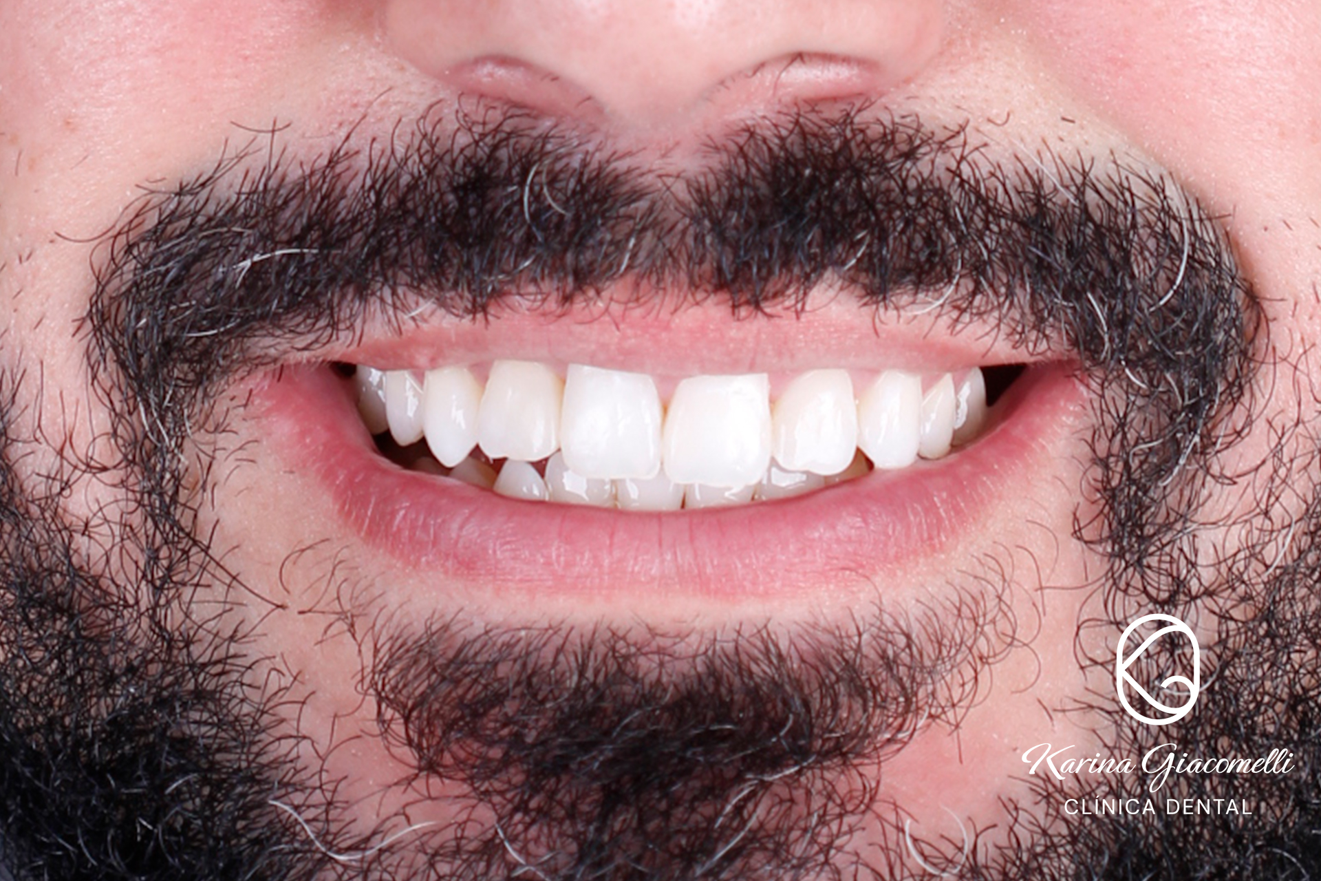 Caso-Blanqueamiento-2