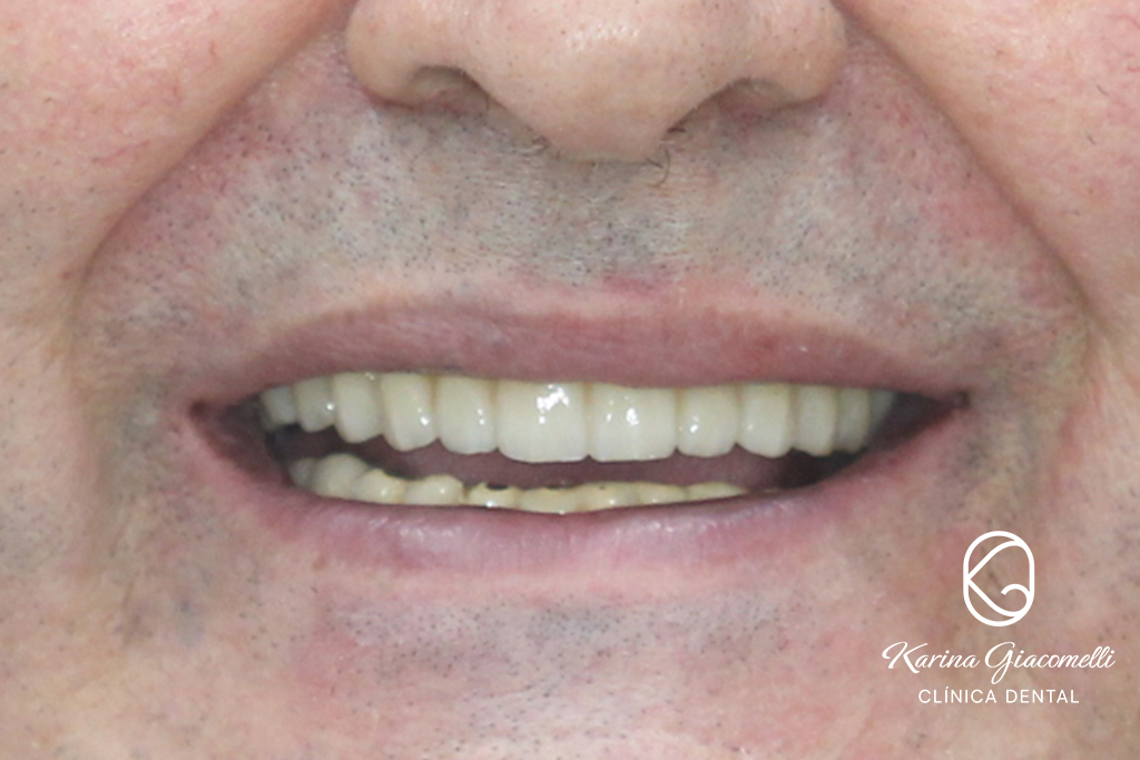 Caso-Implantes-Rehabilitacion-2