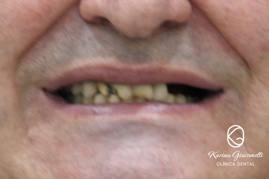 Caso-Implantes-Rehabilitacion