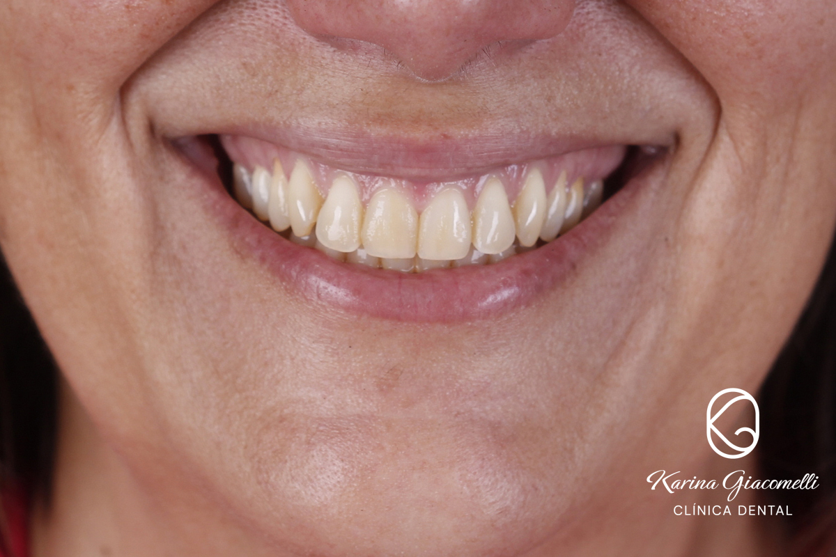 blanqueamiento-dental-abril-2023-antes
