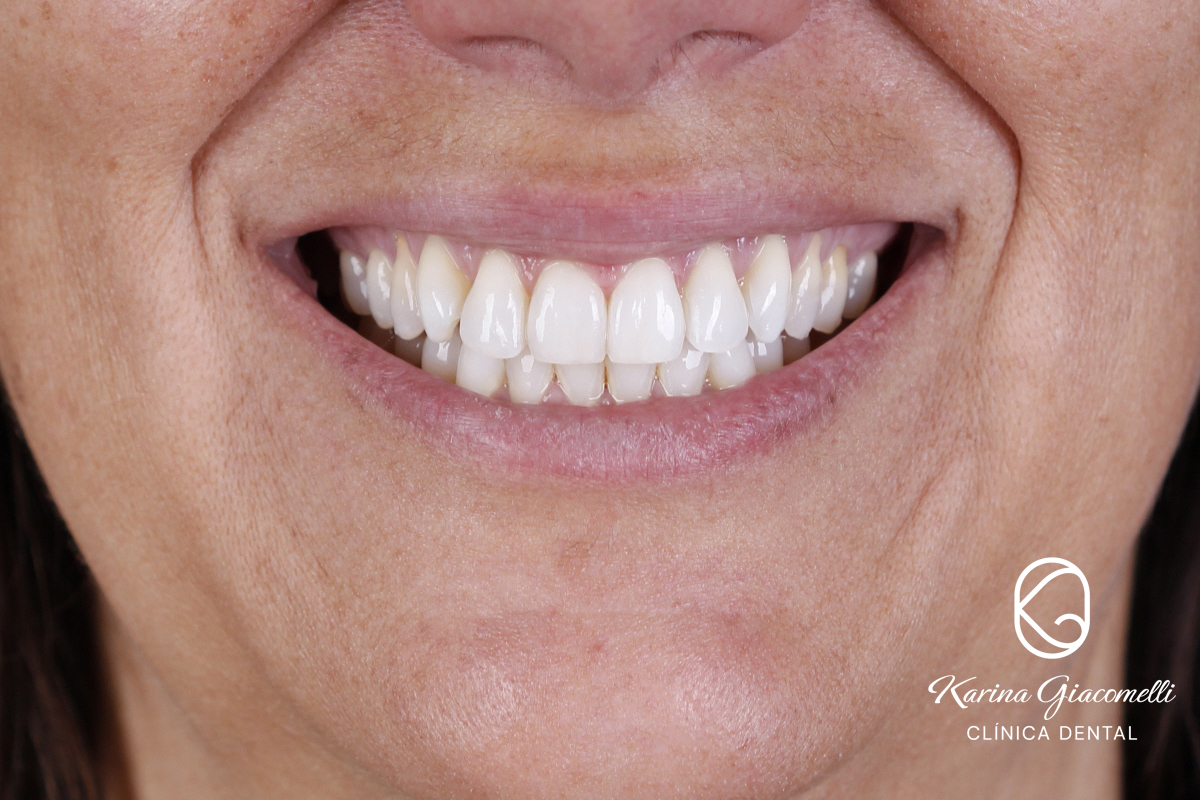 blanqueamiento-dental-abril-2023-despues