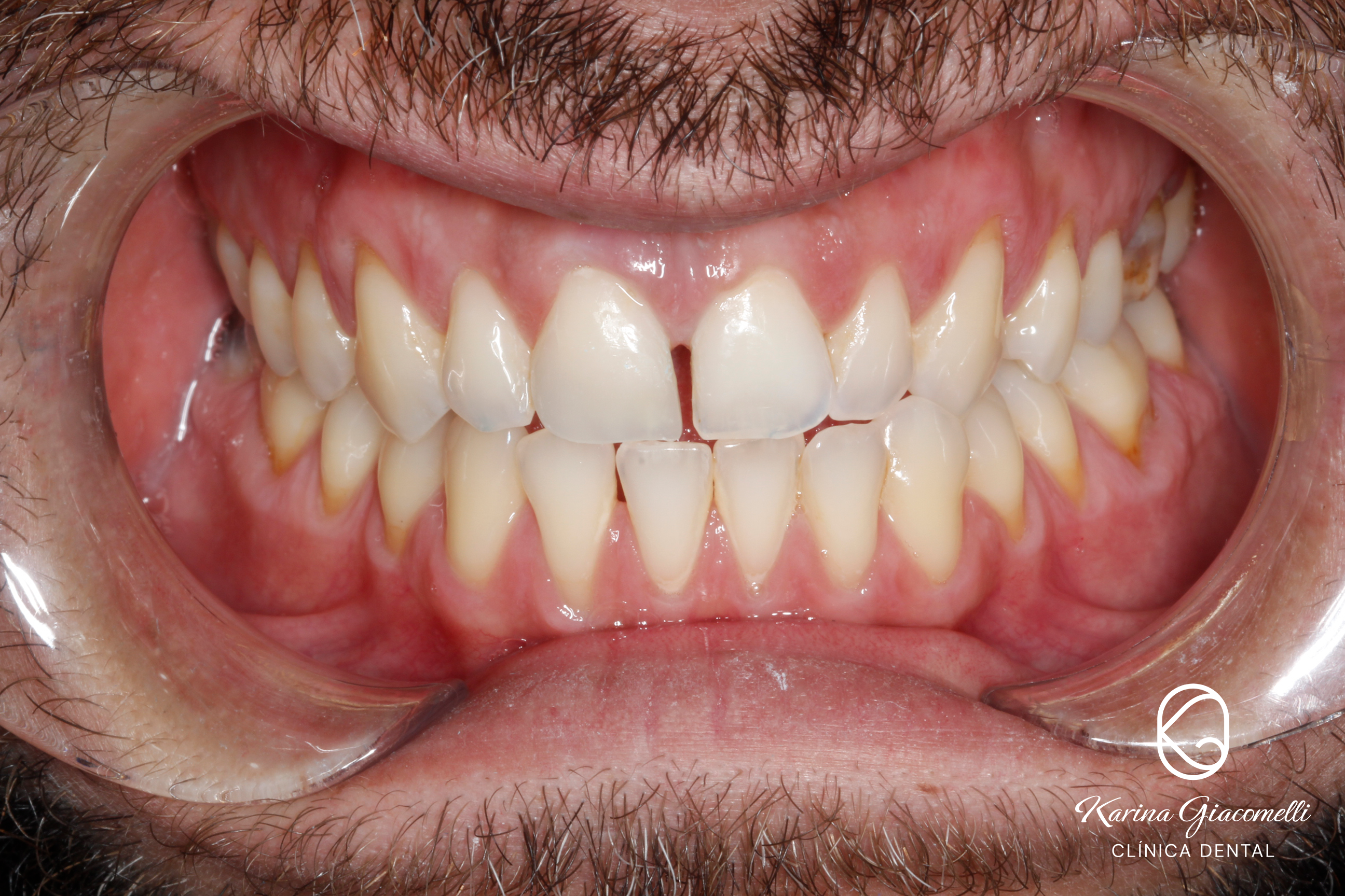 Carillas Composite 1 – Clinica Dental Karina Giacomelli