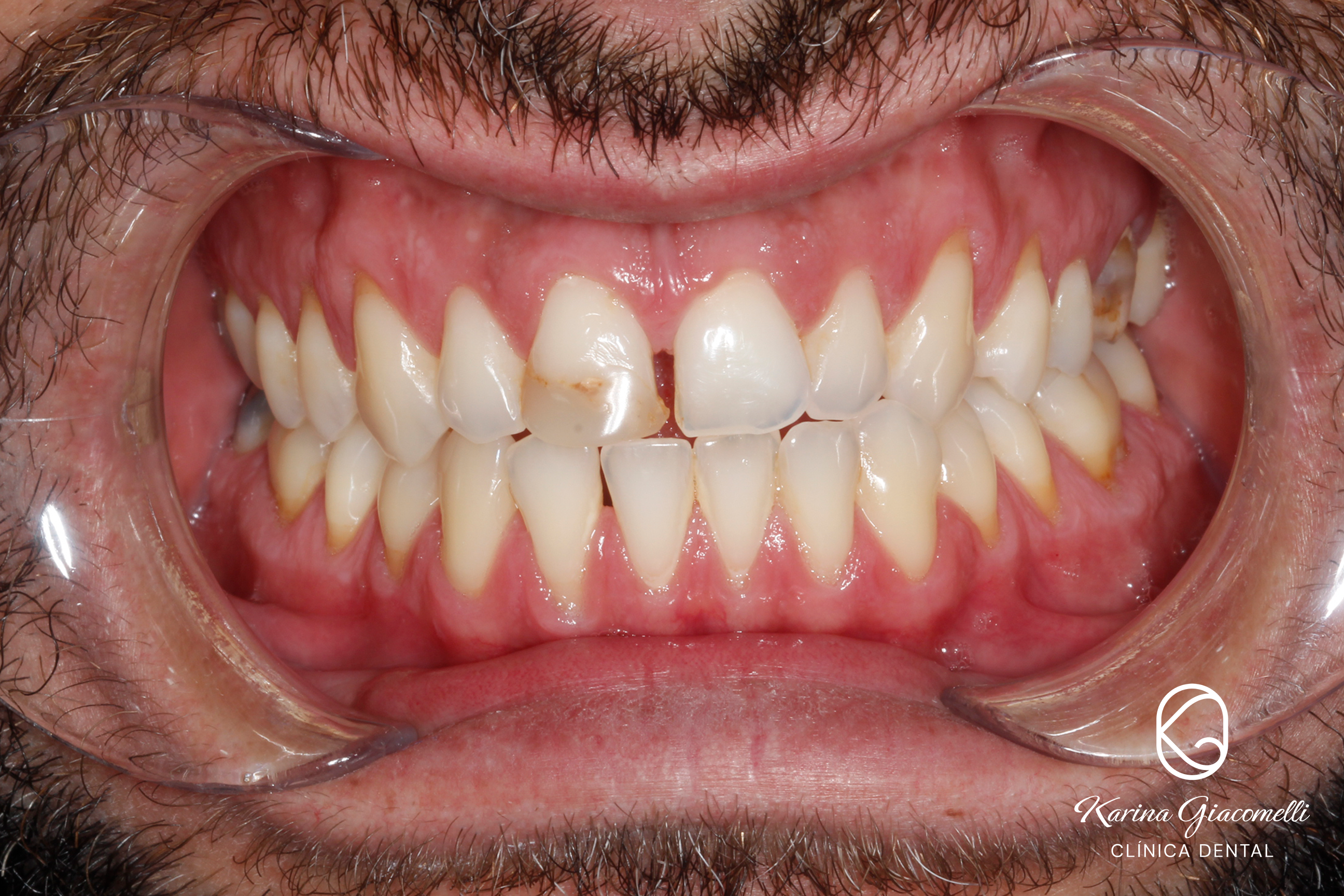 Carillas Composite 2 – Clinica Dental Karina Giacomelli